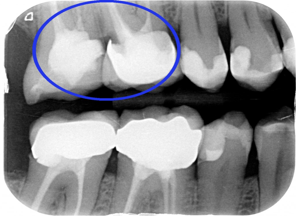 Allungamento di corona clinica 001