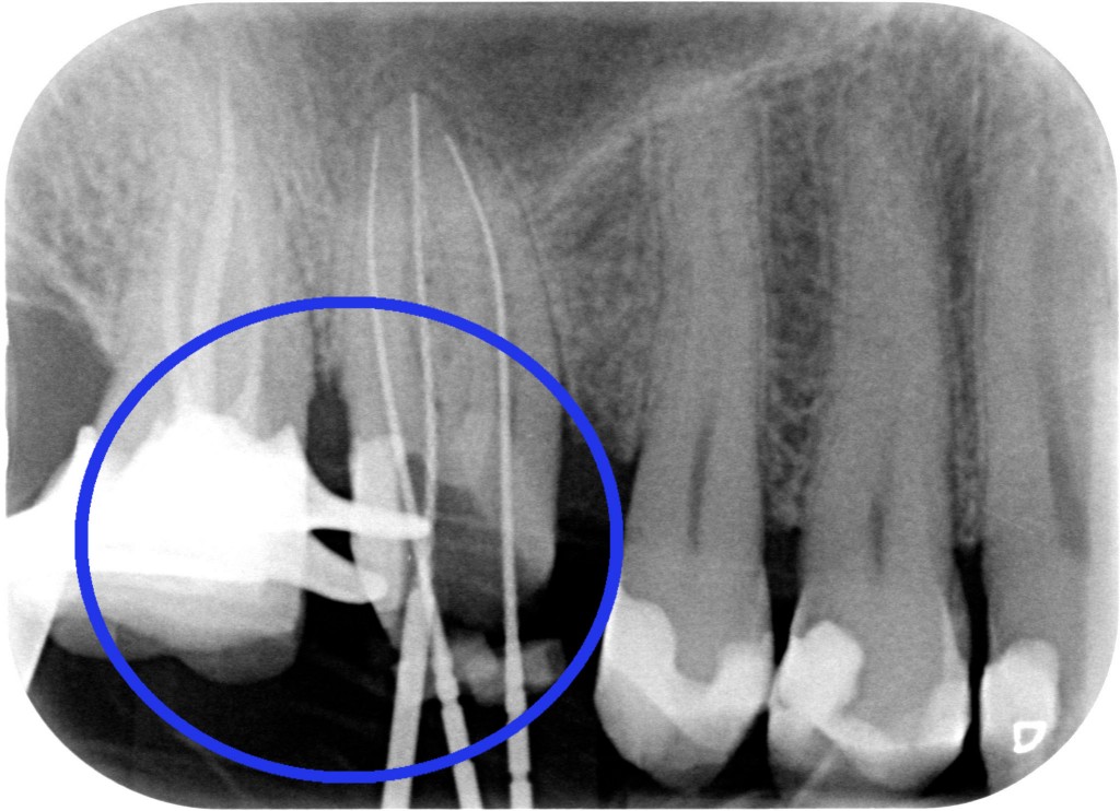Allungamento di corona clinica 002
