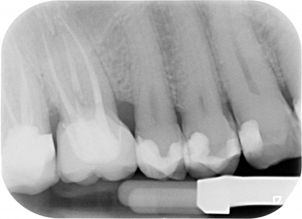 Allungamento di corona clinica 004