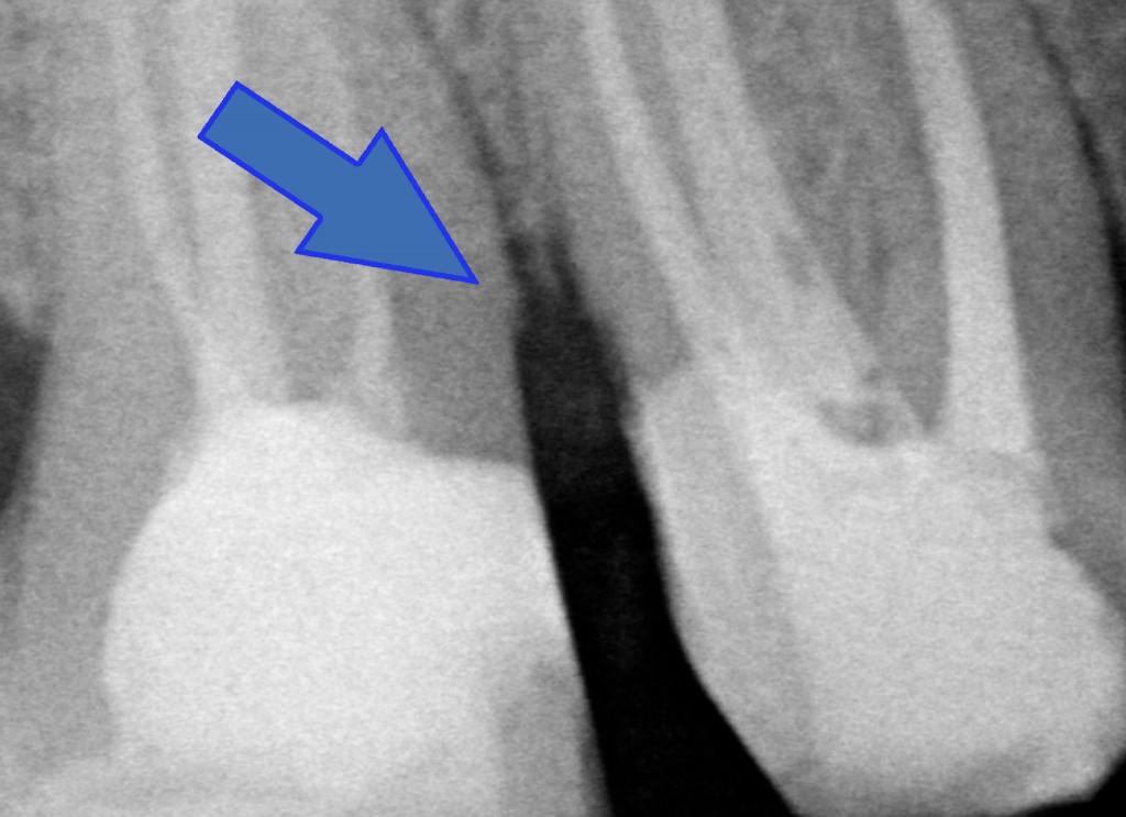 Allungamento di corona clinica 005