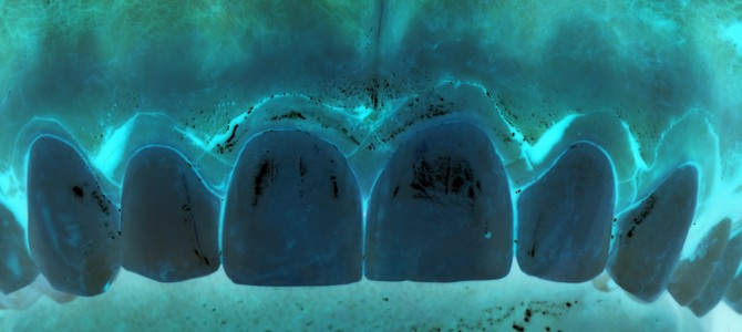 LA TECNICA CHIRURGICA DELL’ ALLUNGAMENTO DI CORONA CLINICA