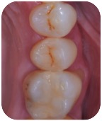 Riassorbimento esterno - Finale Bongioanni