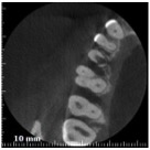 Riassorbimento esterno - Cone beam transassiale