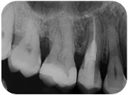 Riassorbimento esterno - Radiografia finale Bongioanni
