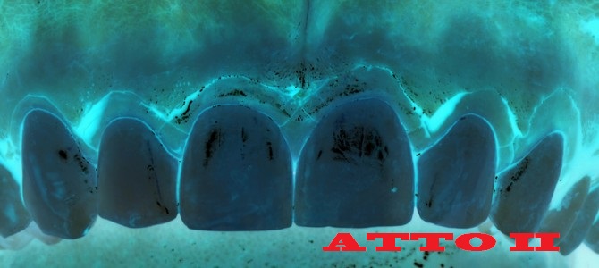 LA TECNICA CHIRURGICA DELL’ ALLUNGAMENTO DI CORONA CLINICA: ATTO II