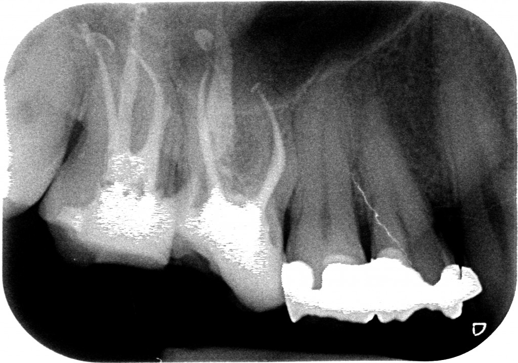 Falsa strada - rx finale