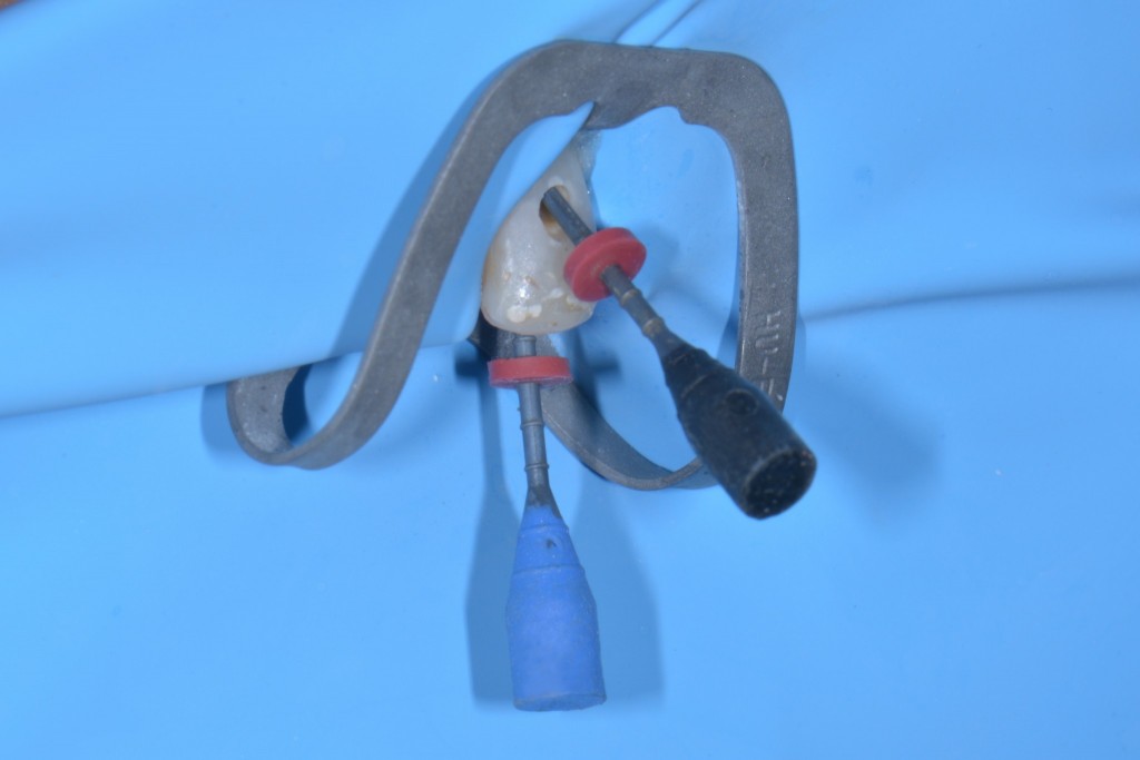 Dens in dente - Accesso doppio