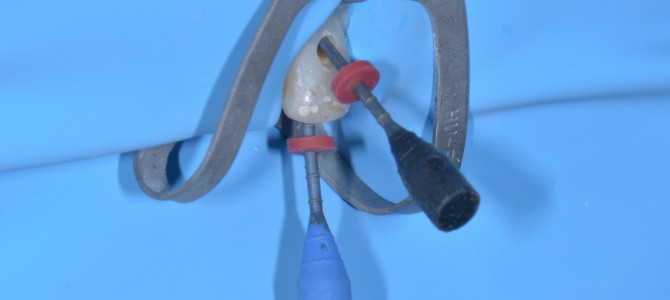 DENS IN DENTE: SAI RICONOSCERLO E TRATTARLO? DENS IN DENTE: SAI RICONOSCERLO E TRATTARLO?