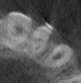 Dens in dente - Cone beam tranassiale