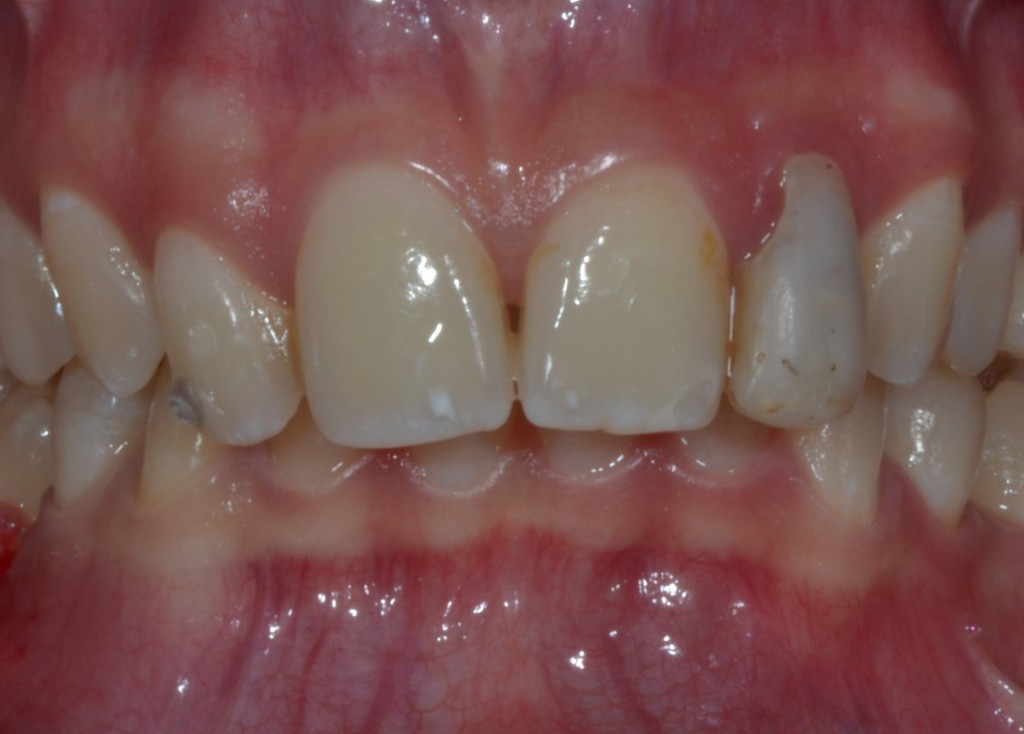 Dens in dente - Iniziale