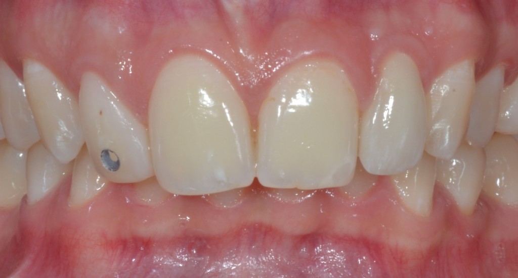 Dens in dente - Controllo a 6 mesi