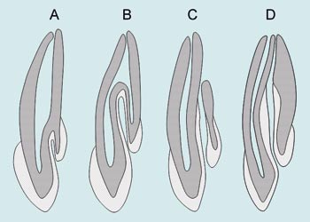 Dens in dente - Classificazione