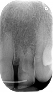 Dens in dente - Dancing dente