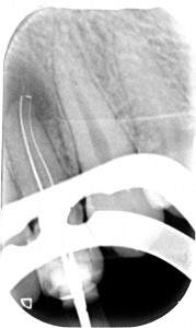 Dens in dente - lunghezza di lavoro