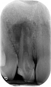 Dens in dente - rx iniziale
