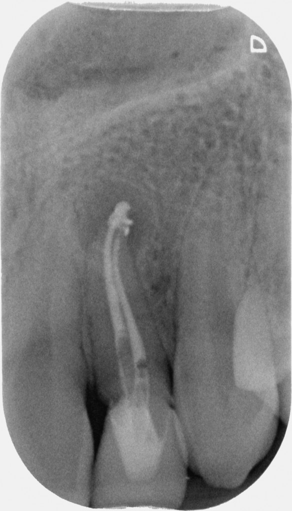 Dens in dente - Rx di controllo