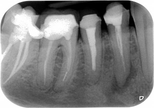 Thermafil - Anatomia difficile iniziale