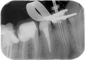 Thermafil - Anatomia difficile lunghezze