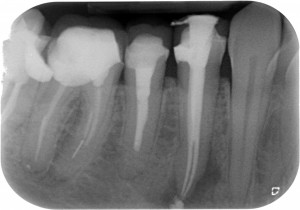 Thermafil - Anatomia difficile finale