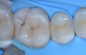 Teflon in odontoiatria - Stampaggio prime classi