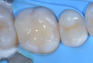 Teflon in odontoiatria - Stampaggio prime classi 3