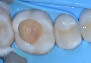 Teflon in odontoiatria - Stampaggio prime classi 5