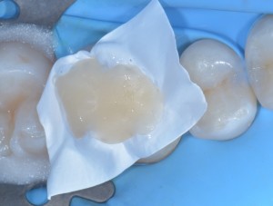 Teflon in odontoiatria - Stampaggio prime classi 7
