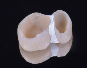 Teflon in odontoiatria - isolamento provvisori