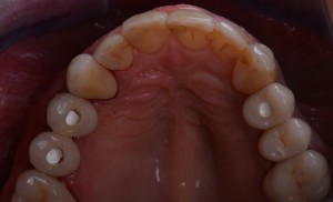 Teflon in odontoiatria - teflon su impianti