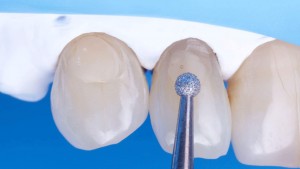 Teflon in odontoiatria - Teflon su diga all'americana