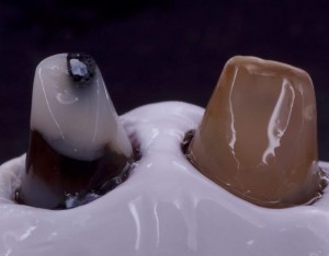 Teflon in odontoiatria - Teflon per cementare corone