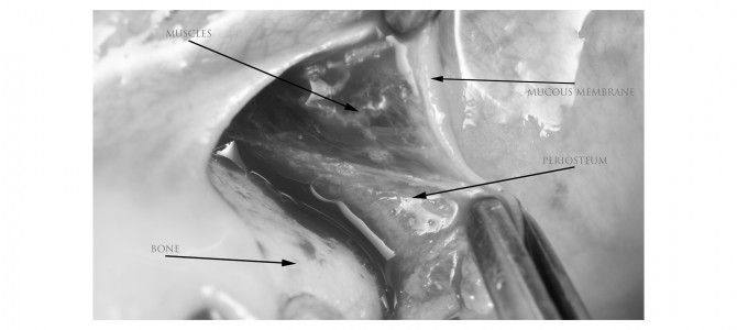 PERCHE’NON E’ VERO CHE UN LEMBO A RIPOSIZIONAMENTO CORONALE ACCORCIA IL FORNICE. O MEGLIO PERCHE’ IMPLANTOLOGI E PARODONTOLOGI NON SI CAPISCONO.