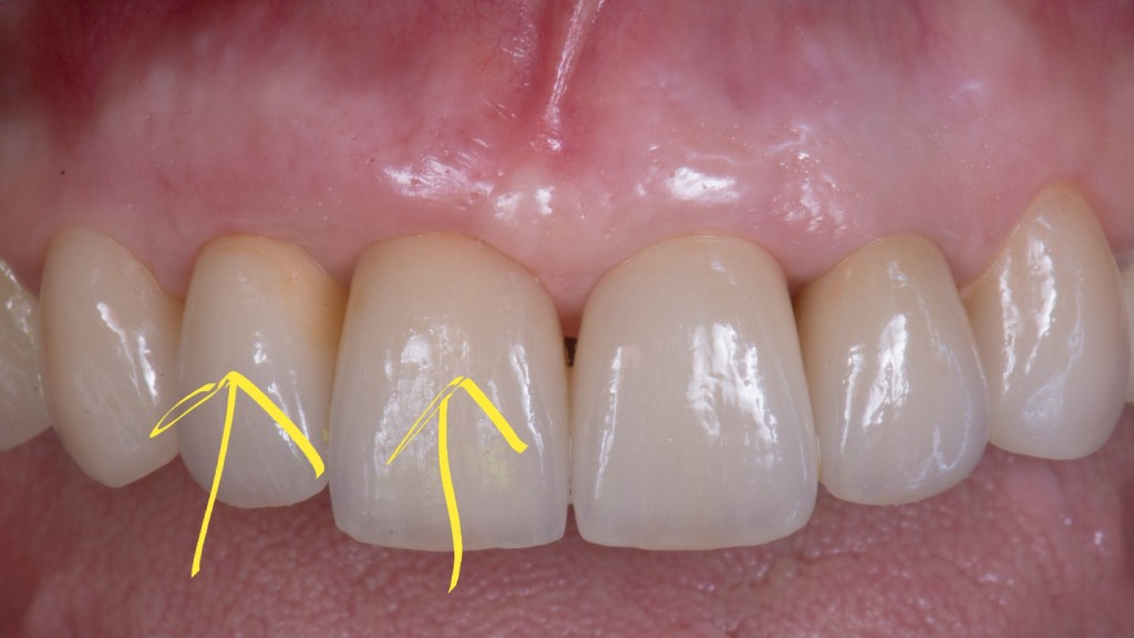 gestione dei tessuti molli - esempio frontali