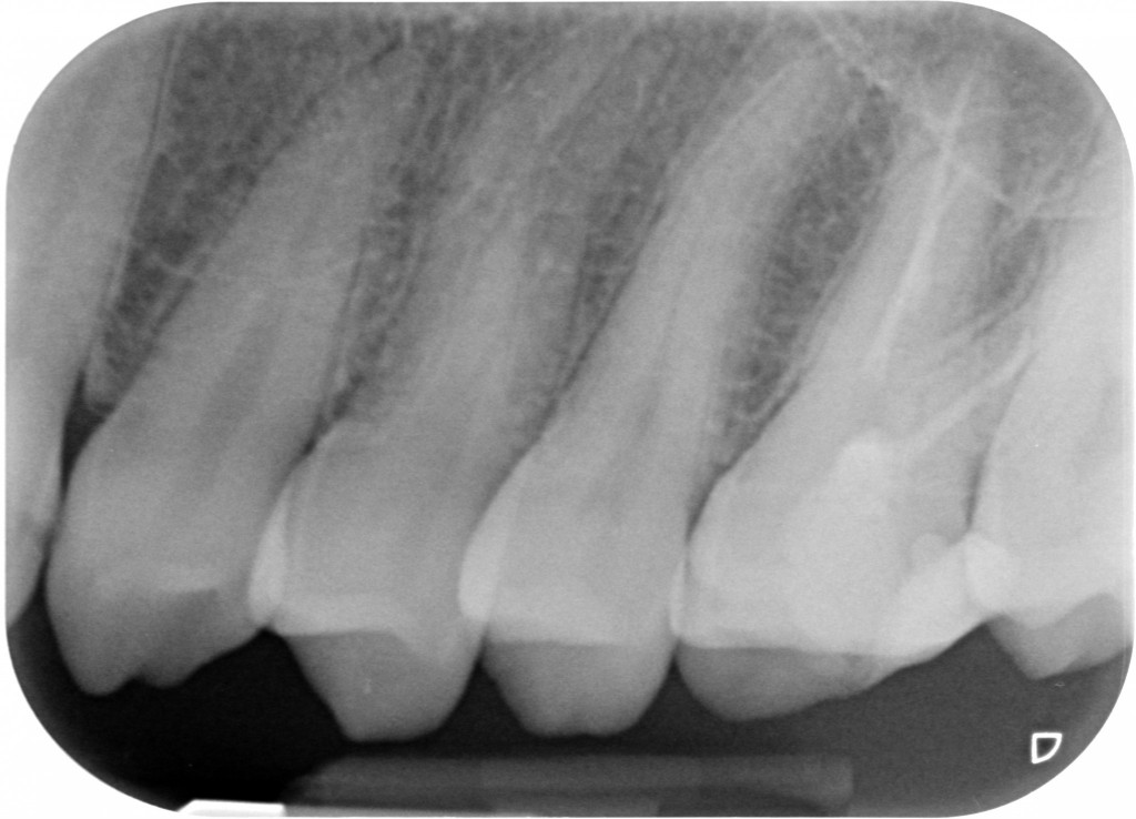 Urgenze - rx periapicale