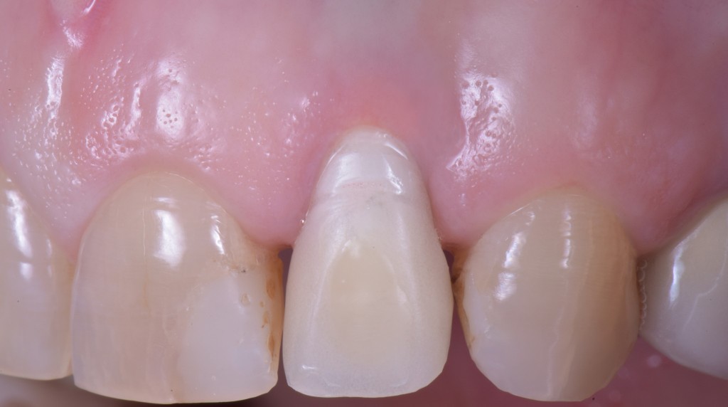 gestione dei tessuti molli - risoluzione della fistola