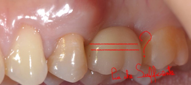 COSA DIAVOLO E’ QUESTA GESTIONE DEI TESSUTI MOLLI – ATTO SECONDO