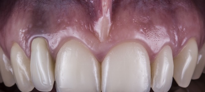 QUANDO TOGLI UN DENTE SUCCEDE UNA COSA INCREDIBILE… INFATTI QUALCUNO ANCORA NON CI CREDE.