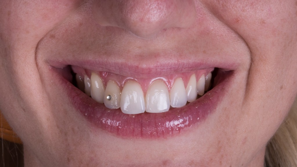 SE NON C’E’ TESSUTO CHERATINIZZATO E’ UN BEL PROBLEMA6