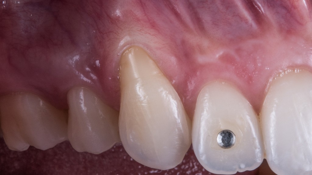 SE NON C’E’ TESSUTO CHERATINIZZATO E’ UN BEL PROBLEMA3