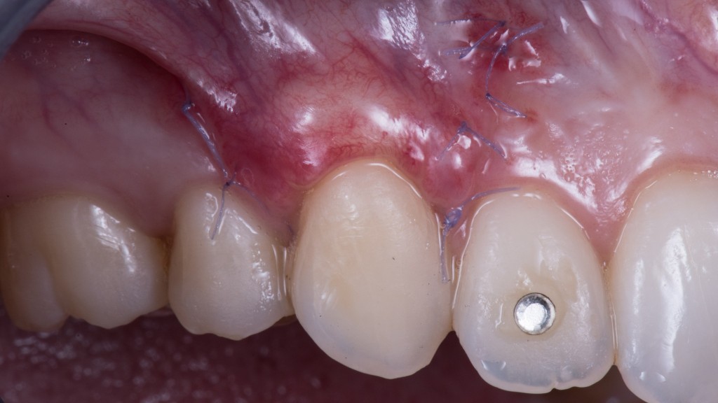 SE NON C’E’ TESSUTO CHERATINIZZATO E’ UN BEL PROBLEMA9