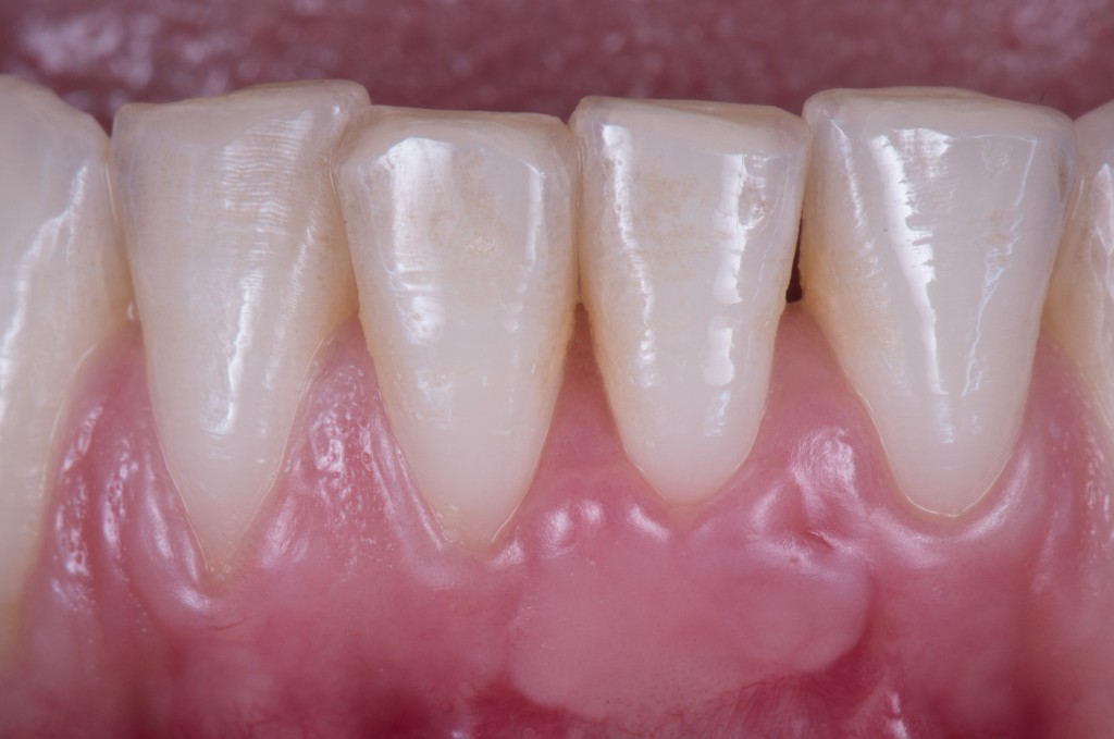 SE NON C’E’ TESSUTO CHERATINIZZATO E’ UN BEL PROBLEMA5