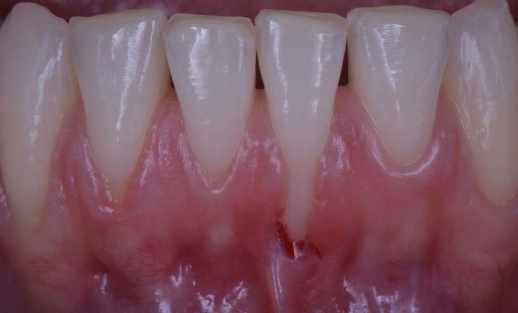 SE NON C’E’ TESSUTO CHERATINIZZATO E’ UN BEL PROBLEMA4