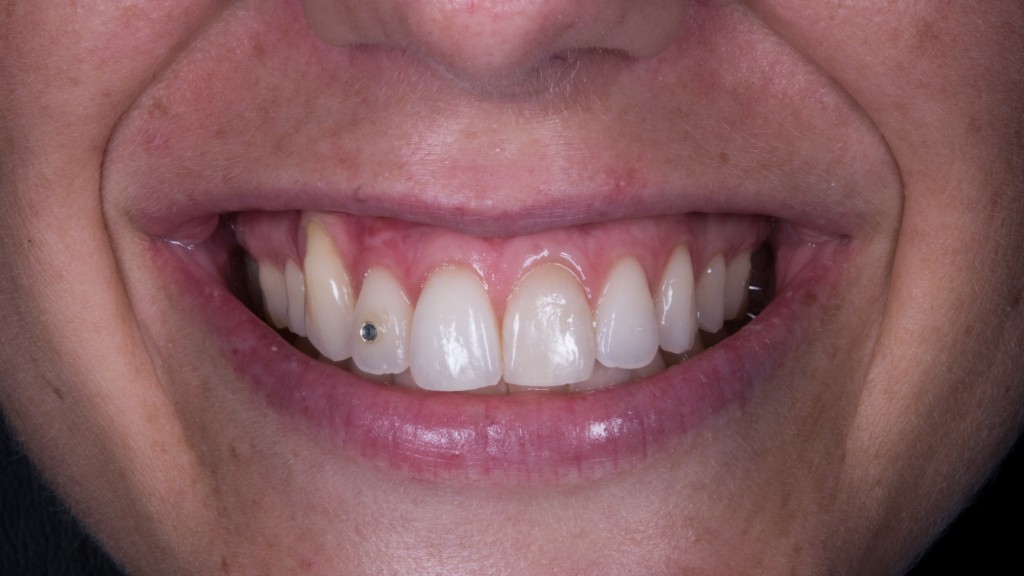 SE NON C’E’ TESSUTO CHERATINIZZATO E’ UN BEL PROBLEMA2