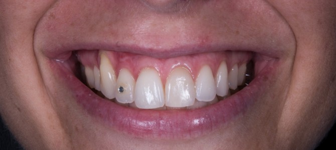 SE NON C’E’ TESSUTO CHERATINIZZATO E’ UN BEL PROBLEMA