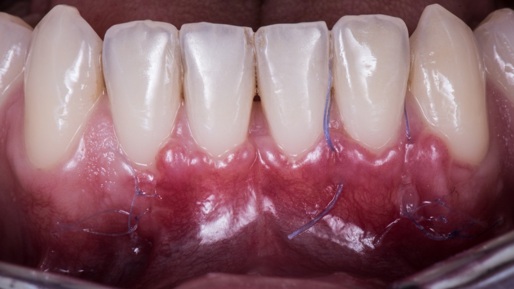 LA PRIMA TECNICA SEGRETA PER NON ACCORCIARE IL FORNICE IN CHIRURGIA MUCOGENGIVALE 02