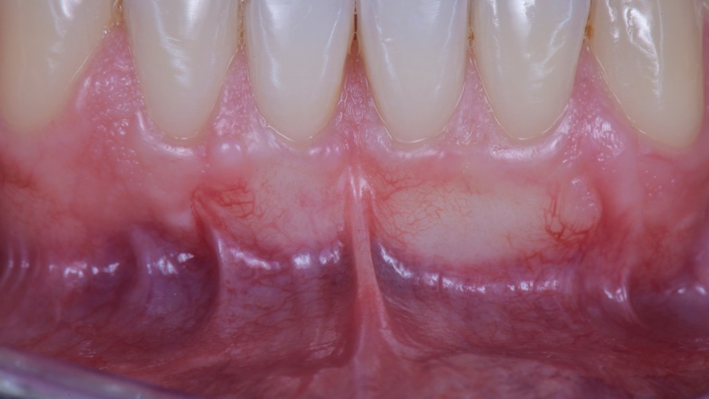 LA PRIMA TECNICA SEGRETA PER NON ACCORCIARE IL FORNICE IN CHIRURGIA MUCOGENGIVALE 04