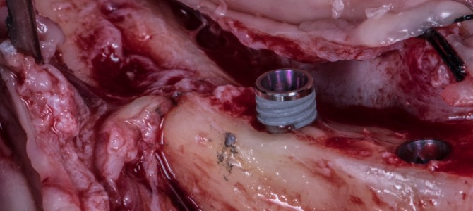 COME ESPORRE IL NERVO MENTONIERO SENZA DANNEGGIARLO [VIDEO]