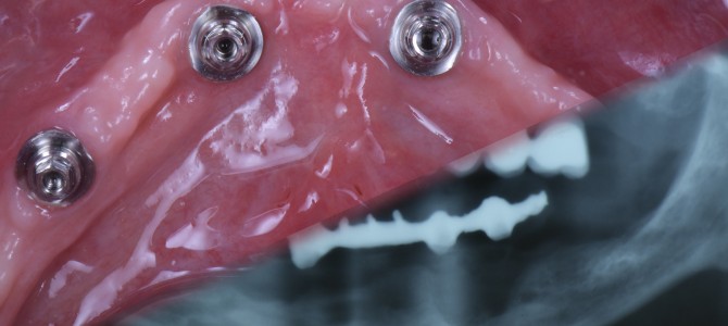 DAGLIELI ‘STI DENTI FISSI AI TUOI PAZIENTI!