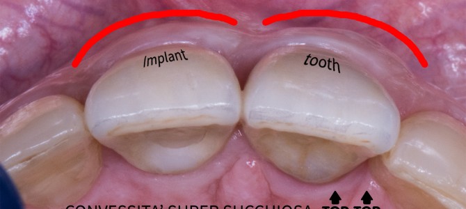 [video chirurgico] DOPO IL WEBINAR DI LUNEDI’ SALIAMO UN PO’ DI COMPLESSITA': QUANDO VUOI METTERCI ANCHE UN PO’ DI OSSO.