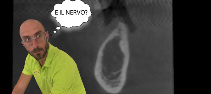 QUANDO NELLA TAC NON SI VEDE IL NERVO QUANDO NELLA TAC NON SI VEDE IL NERVO